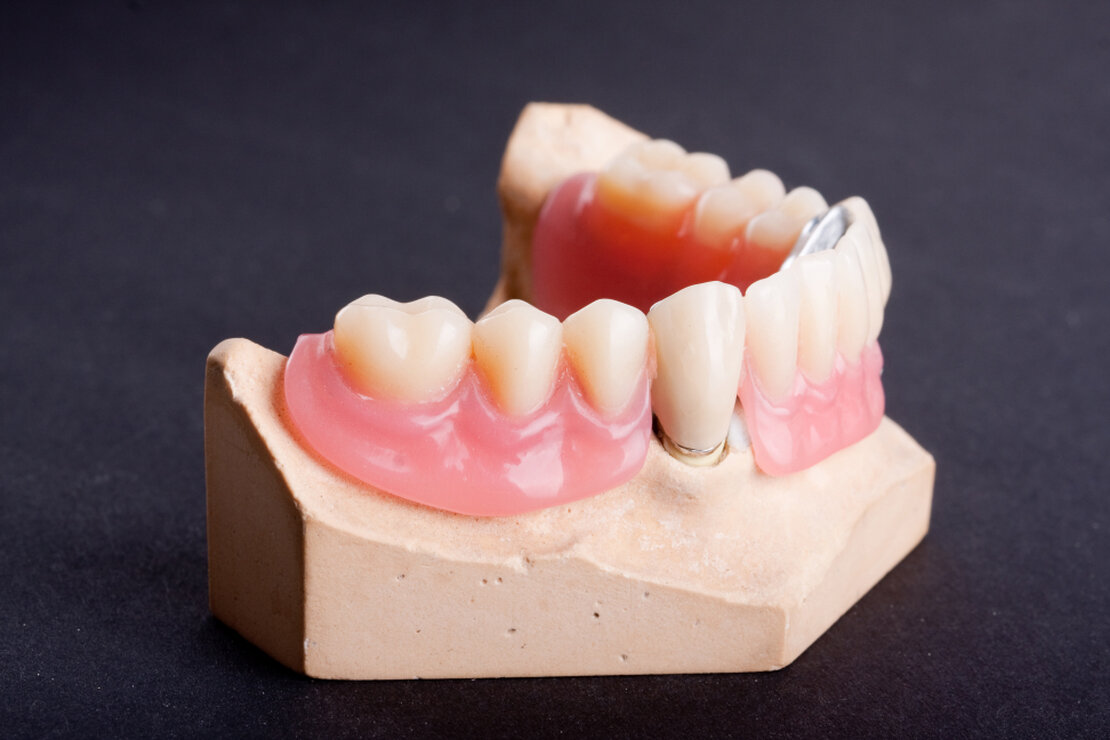 Kombiarbeit im Dentallabor