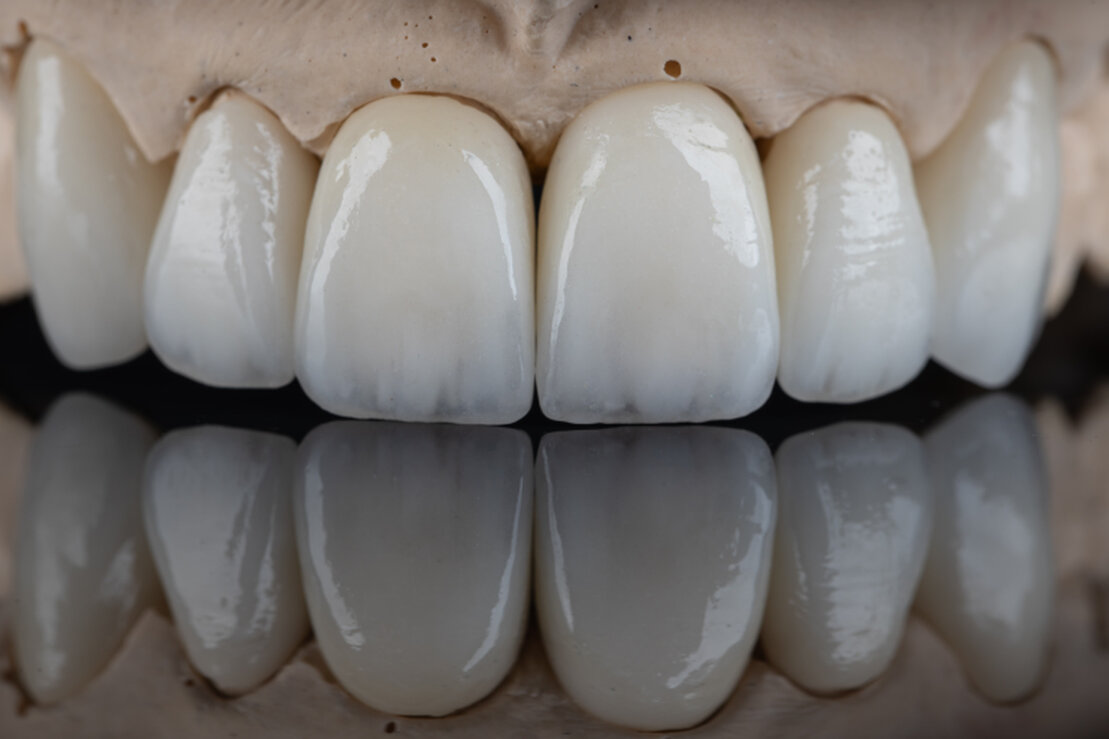 Implantatgetragene Krone im Dentallabor
